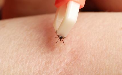 Россиянам рассказали о неочевидных симптомах укуса клеща Россиянам рассказали о неочевидных симптомах укуса клеща