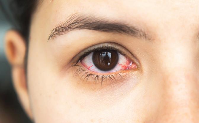 Червь поселился в глазу у сибирячки после укуса комара Червь поселился в глазу у сибирячки после укуса комара
