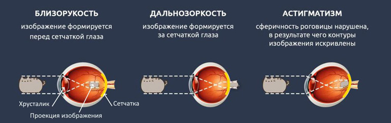 На сетчатке глаза формируется. Правильная светопроекция в офтальмологии. Лазеры в офтальмологии книга. Вопросы лазерной офтальмологии. Изейкония это в офтальмологии.
