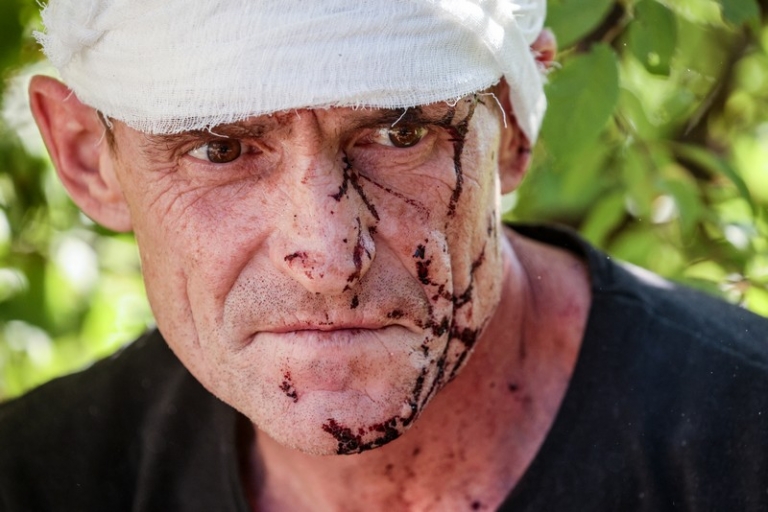 На фото: мужчина, пострадавший в результате обстрела ВСУ