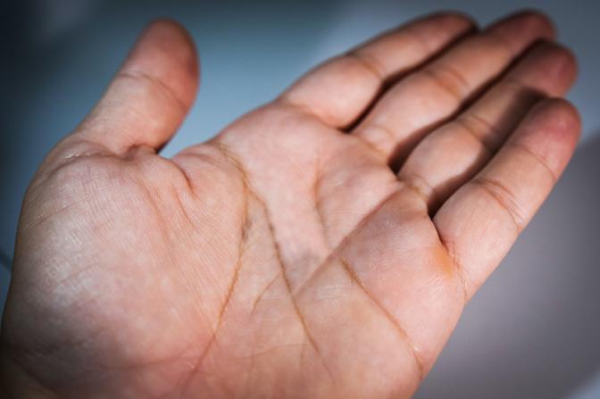 Названа опасная причина потливых ладоней