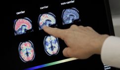 Альцгеймер, изыди! Китайцы нашли лекарство от главной болезни старости