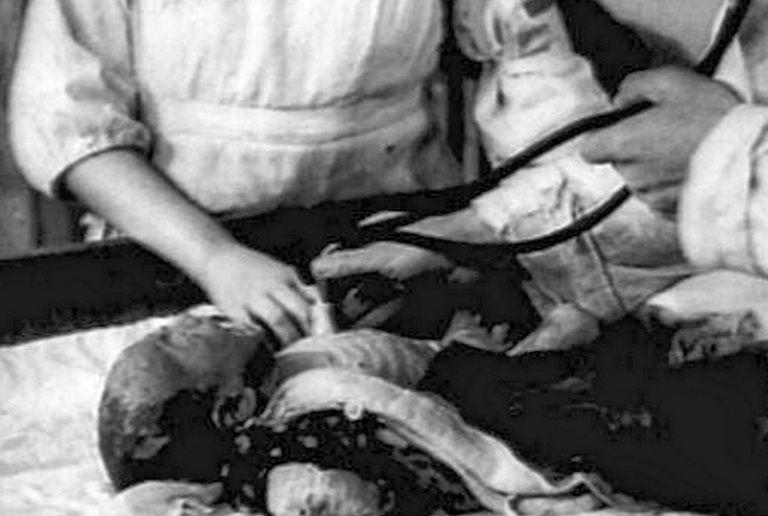 На фото: жертва атомной бомбардировки Хиросимы, 1945 год.