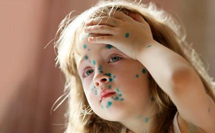 Ветряная оспа в курсе, что с "короной" Минздрав накосячил - и бесчинствует в российских регионах