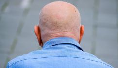 Известное растение оказалось связано с замедлением облысения