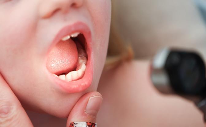 Скрытая угроза во рту: как не пропустить смертельный сигнал